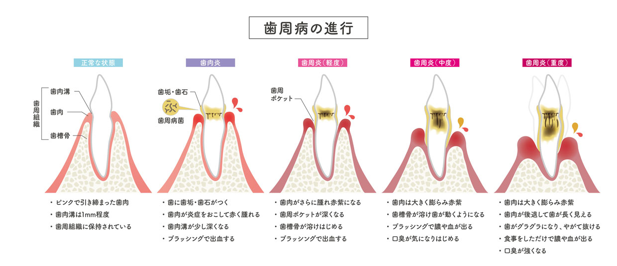 歯周病・歯槽膿漏の進行度合いと症状